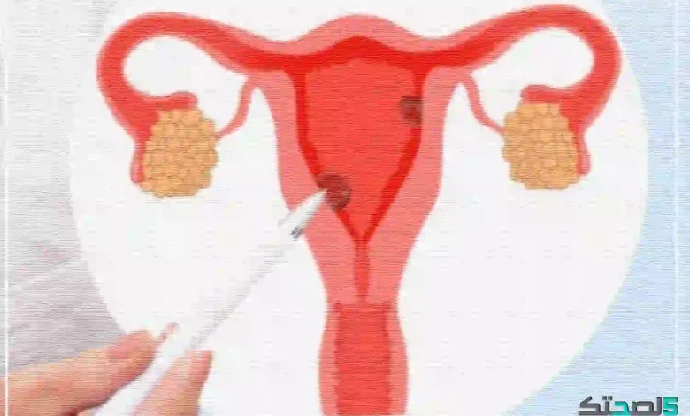 علاج بطانة الرحم المهاجرة بالقسط الهندي