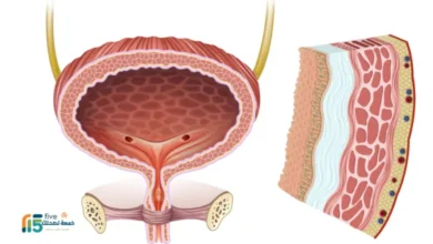 ما الذي يسبب سمك جدار المثانة
