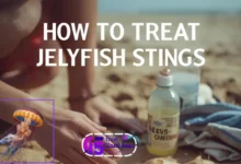 كيفية علاج لسعات قنديل البحر
