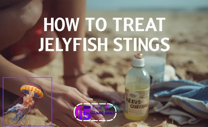 كيفية علاج لسعات قنديل البحر