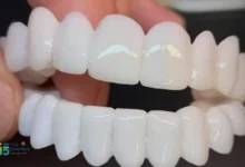 الفينير المتحرك