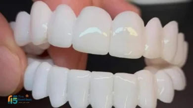 الفينير المتحرك