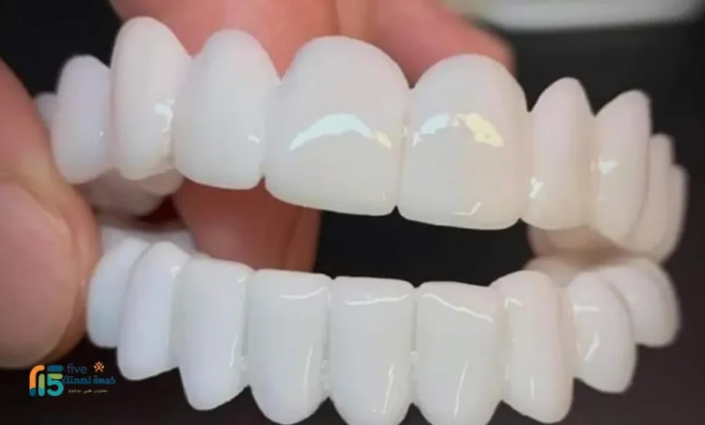 الفينير المتحرك