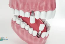 افضل انواع زراعة الاسنان 2024