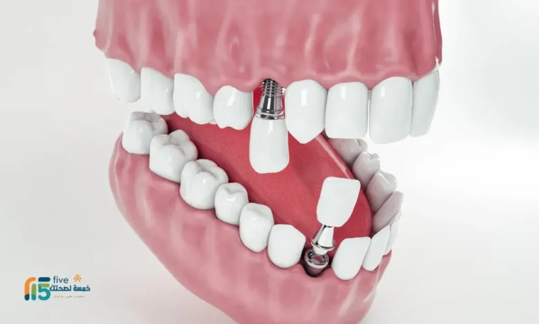 افضل انواع زراعة الاسنان 2024