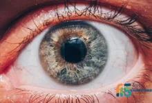 التهاب العنبية