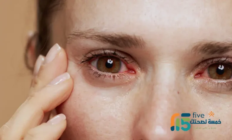 التهابات قزحية العين