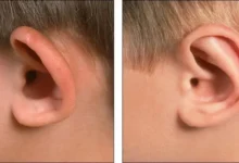 علاج الأذن البارزة في المنزل