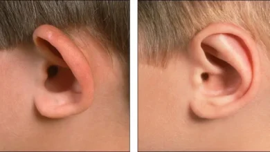 علاج الأذن البارزة في المنزل