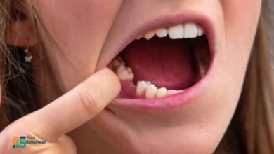 علاج اللثة بعد خلع الضرس