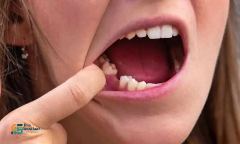 علاج اللثة بعد خلع الضرس