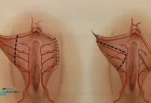 عملية تجميل الشفرتين قبل وبعد