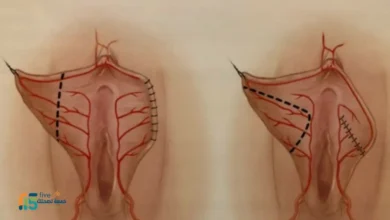 عملية تجميل الشفرتين قبل وبعد