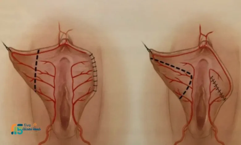 عملية تجميل الشفرتين قبل وبعد