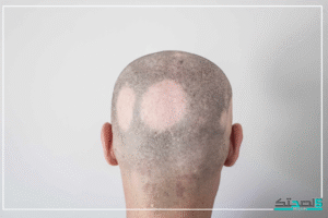 علاج الثعلبة نهائيا علاج الثعلبة نهائيا