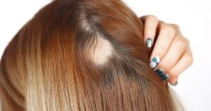 الثعلبة البقعية