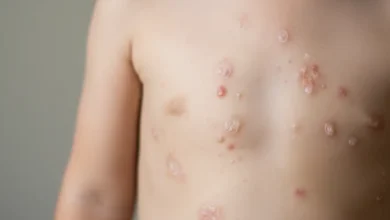 شكل الجدرى المائى