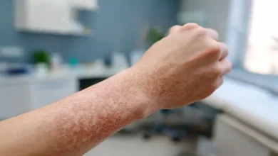 علاج الصدفية نهائيا