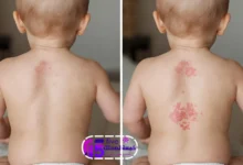 أسرع علاج لالتهاب الحفاضات