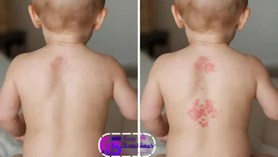 أسرع علاج لالتهاب الحفاضات