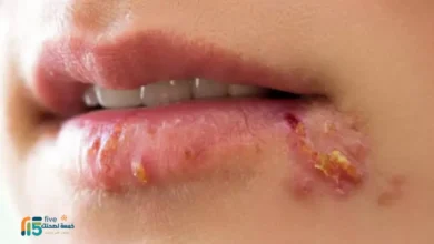 الهربس الفموي عند الأطفال