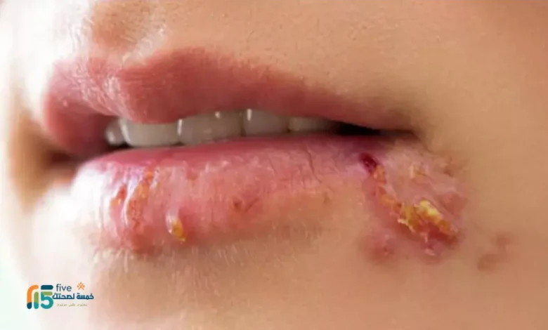 الهربس الفموي عند الأطفال