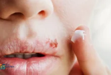 علاج الهربس الفموي للكبار