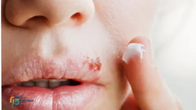 علاج الهربس الفموي للكبار
