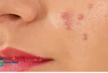 علاج حب الشباب طبيعياً بسرعة بالمنزل