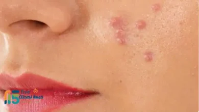 علاج حب الشباب طبيعياً بسرعة بالمنزل