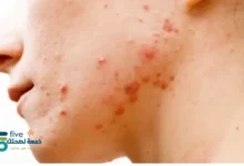 علاج لحبوب الوجه