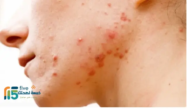 علاج لحبوب الوجه