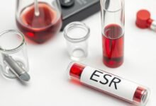 ما هو تحليل ESR وماذا يعني ارتفاعه