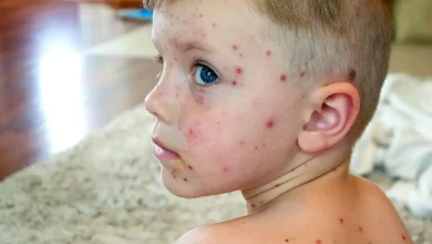 مرض الجدري المائي