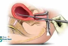 متى يبدأ مفعول ميزوتاك