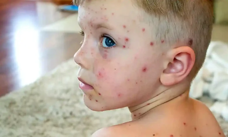 أعراض الجديري المائي