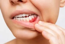 أفضل مضاد حيوي لعلاج التهاب اللثة