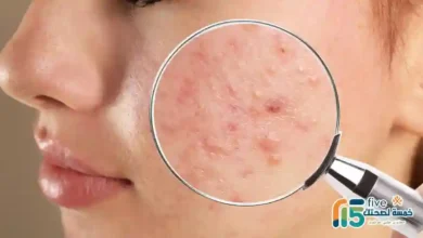 كيفية التخلص من حب الشباب بسرعة