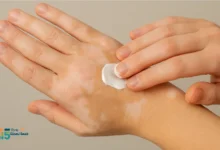 أسرع علاج للبهاق مجرّب