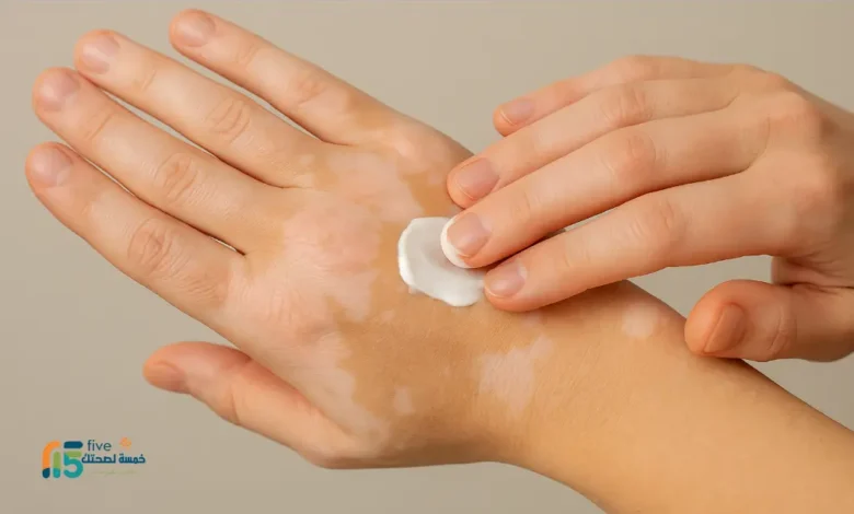 أسرع علاج للبهاق مجرّب