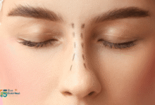 تجربتي مع تجميل الأنف بالليزر