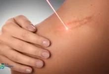 عملية تجميل الحروق