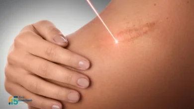 عملية تجميل الحروق