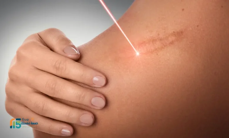 عملية تجميل الحروق