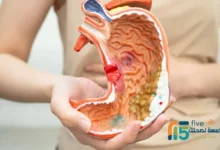 أضرار كيتولاك على المعدة