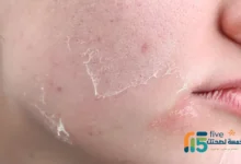 أضرار نيوسبورين على الجلد