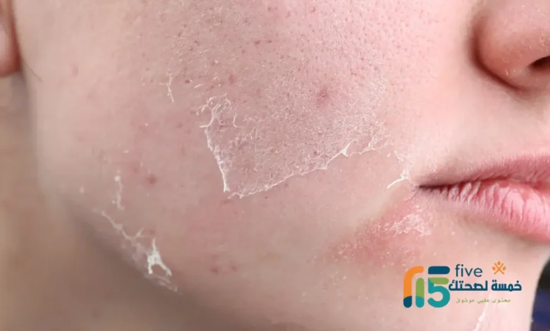 أضرار نيوسبورين على الجلد