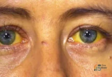 أعراض التهاب الكبد الوبائي