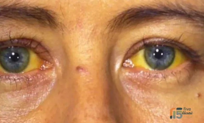 أعراض التهاب الكبد الوبائي