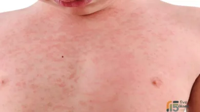 أعراض الحصبة